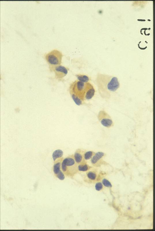 anaplasztikus rák enterobius vermicularis oxyuris
