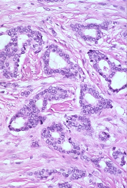 C4: Suspicious of malignancy - Eurocytology