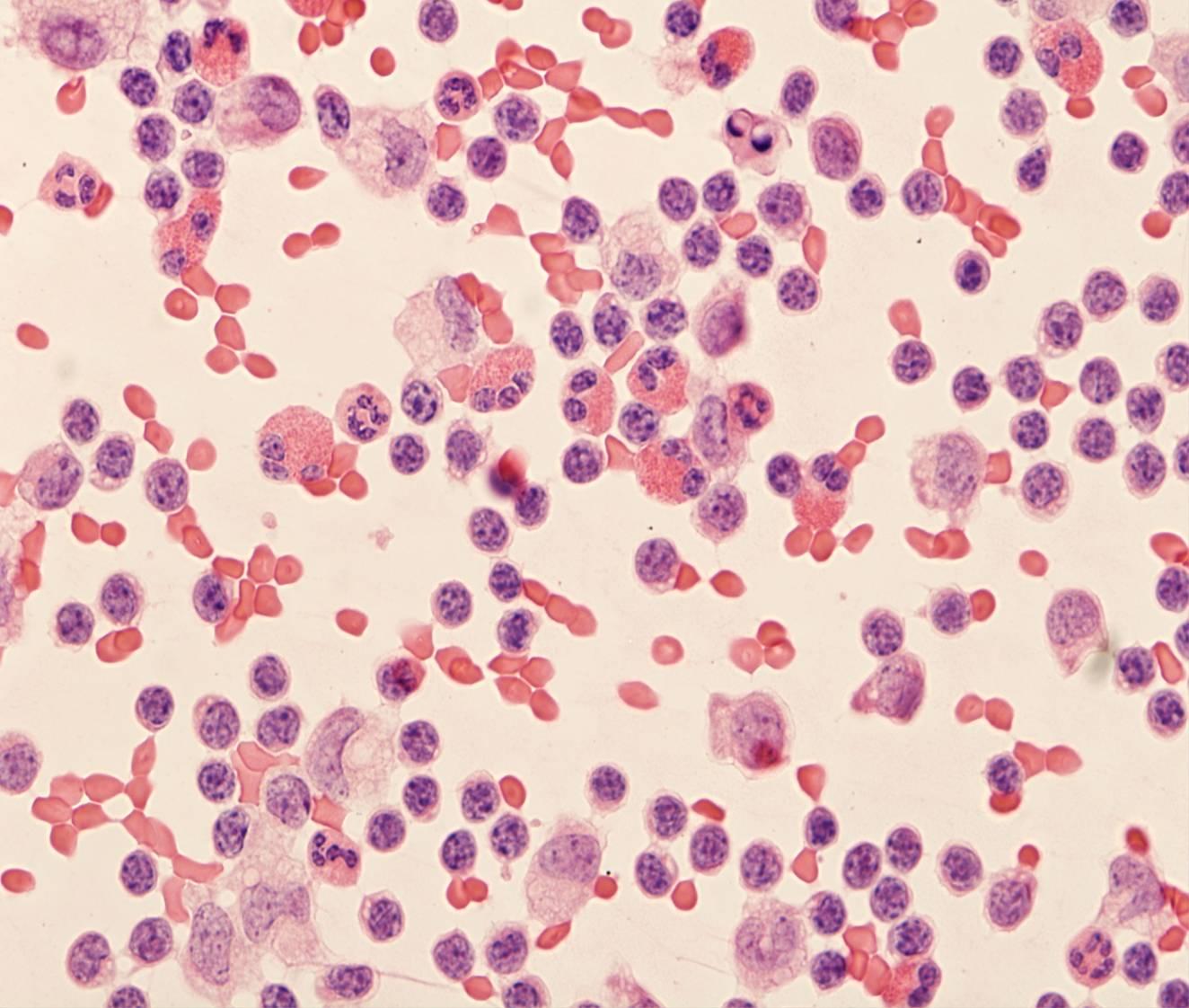 eosinophilic-effusions-eurocytology