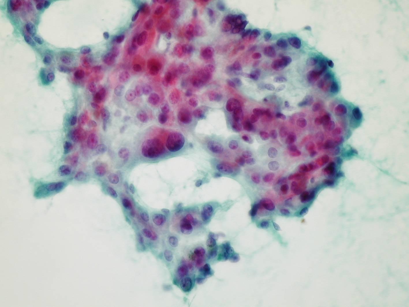 Hepatocellular Carcinoma Hcc Eurocytology