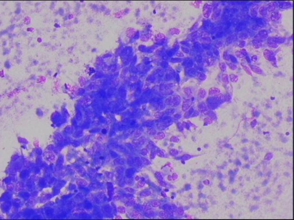 anaplastic carcinoma