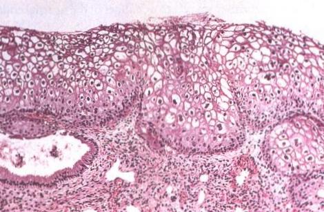 papillomavírus sejt kenet a testen lévő lapos papillómák kezelése