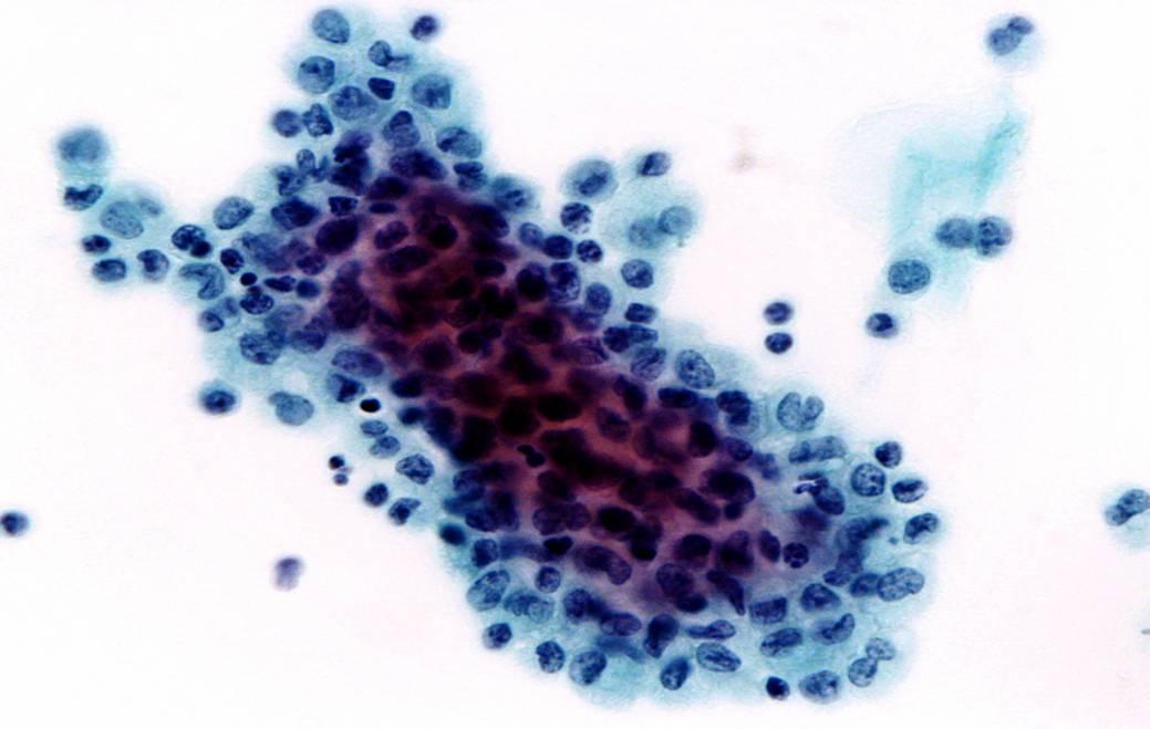 Menopause and endrometrial cells on cervix