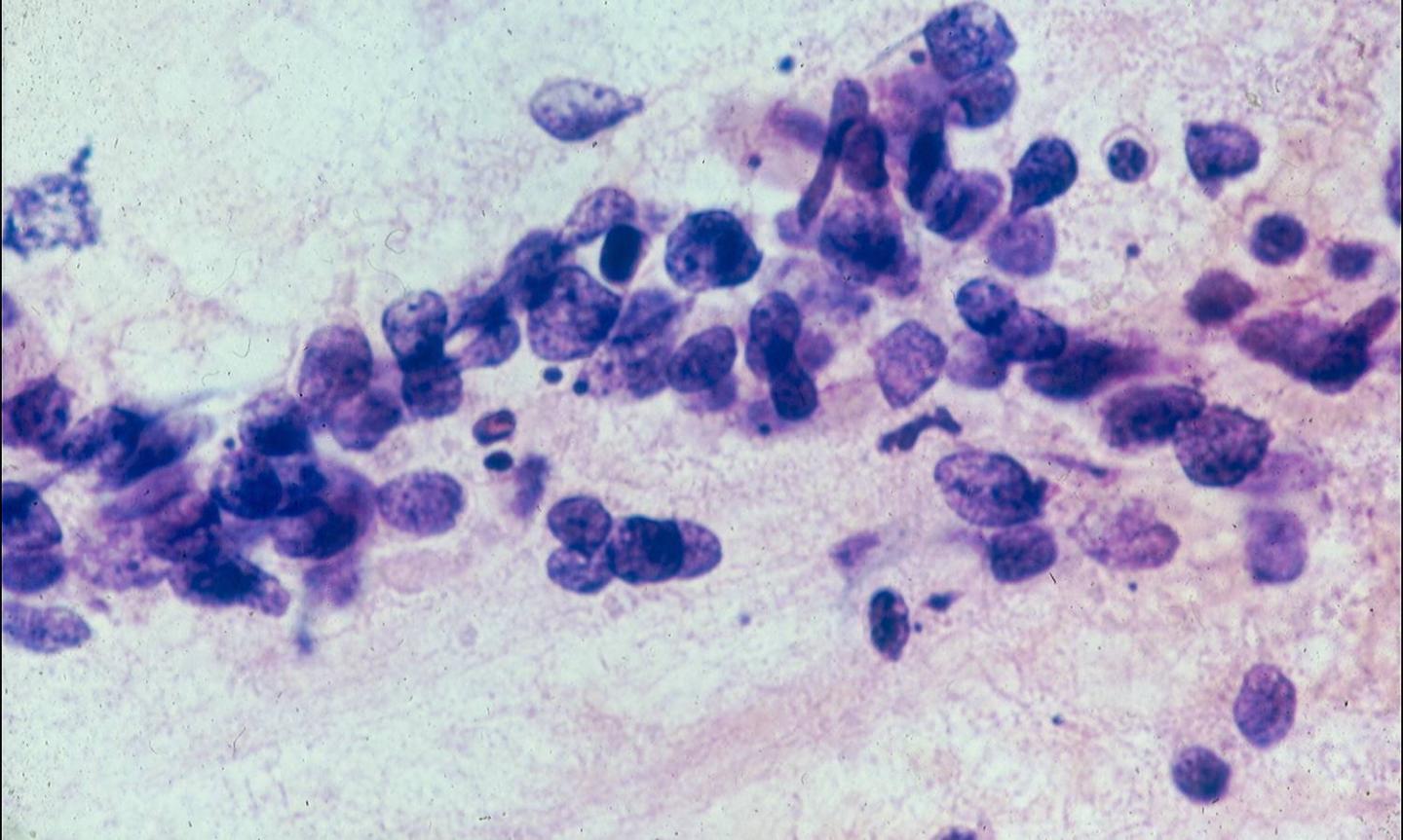 Small cell carcinoma | Eurocytology
